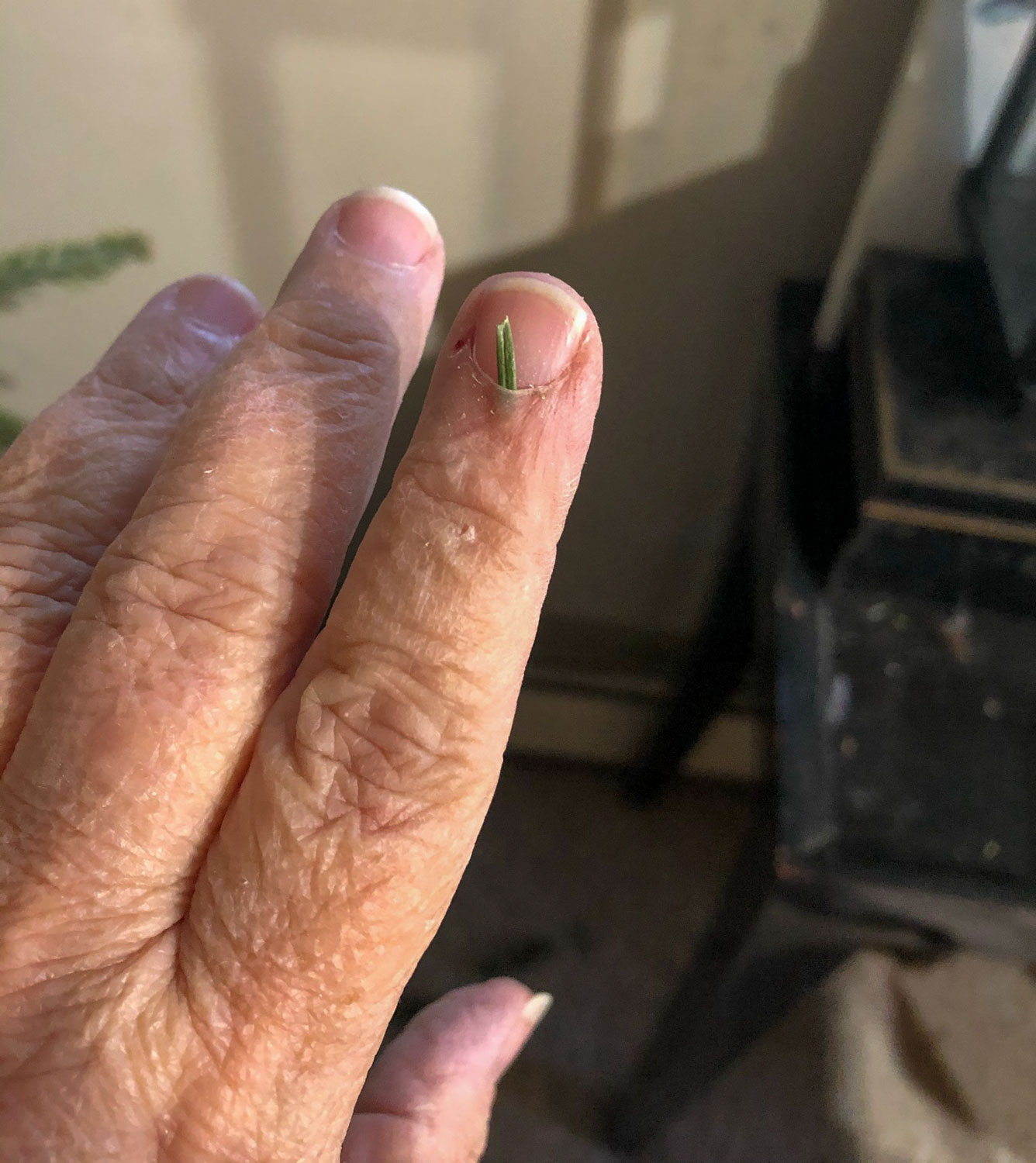 pine needle stuck in finger